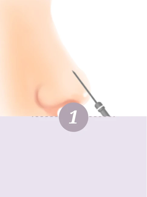Korean 4D Minimally Invasive Rhinoplasty - Step 1