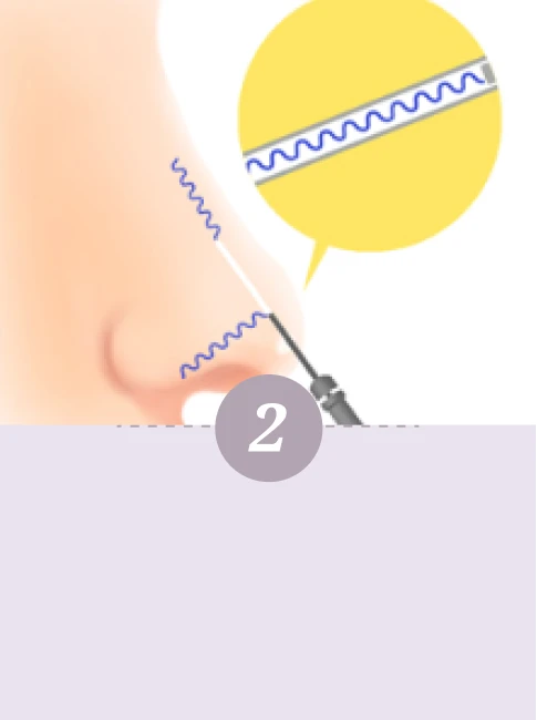 Korean 4D Minimally Invasive Rhinoplasty - Step 2