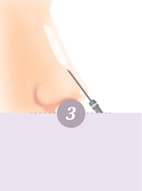 Korean 4D Minimally Invasive Rhinoplasty - Step 3