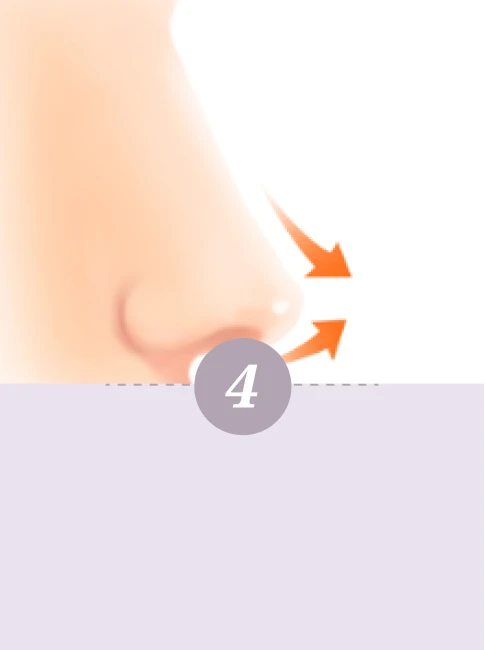 Korean 4D Minimally Invasive Rhinoplasty - Step 4