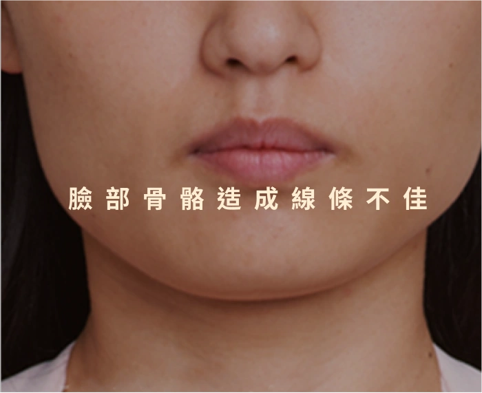 臉部骨骼造成線條不佳