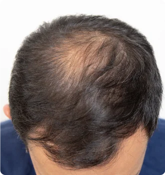 Male Pattern Baldness