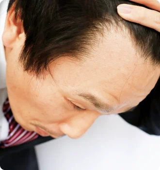 M-Shaped Hairline