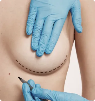 不希望隆乳留下疤痕