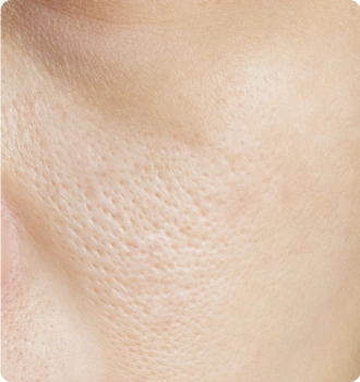 Enlarged pores and rough skin texture