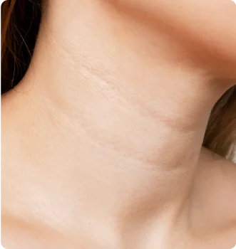 Neck lines