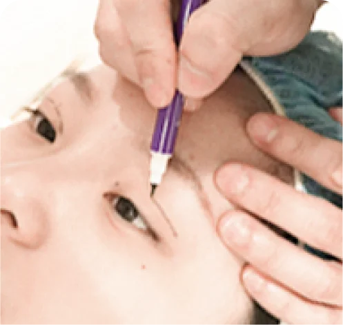 術前拍攝、畫線