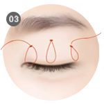 依序在眼周進行縫合