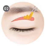 取出眼皮多餘脂肪