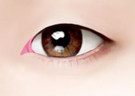 往內把多餘的脂肪和內蒙古摺進行拆除