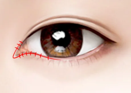 向內縫合可避免疤痕露出