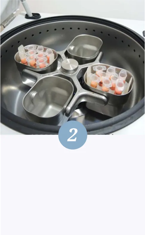 自體脂肪隆乳-第二步驟