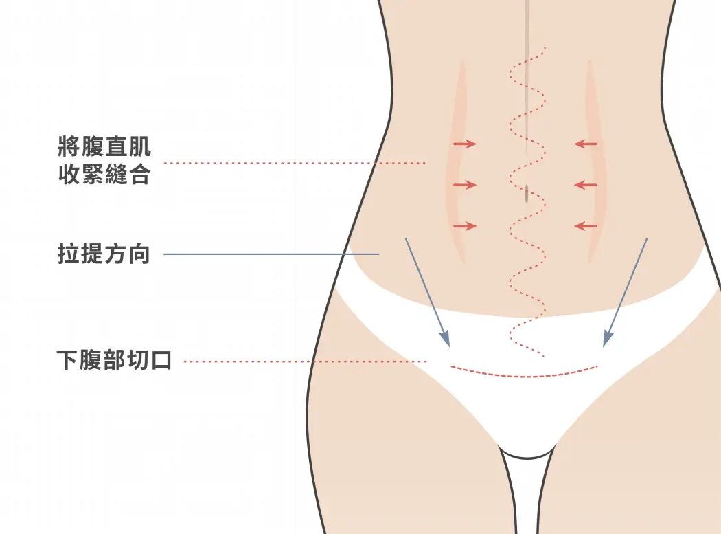 腹部拉皮手術部位示意圖