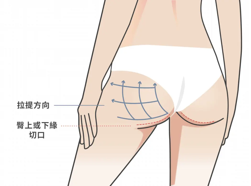 臀部拉皮手術部位示意圖