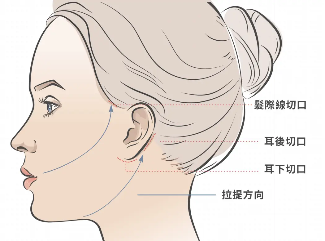 中、下臉拉皮手術部位示意圖