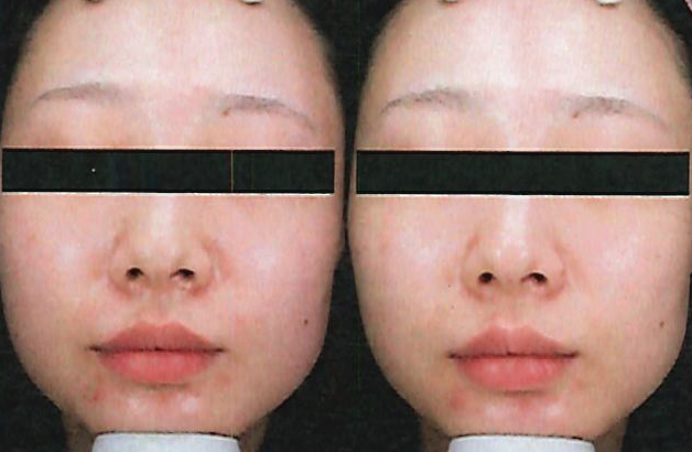 酷雪 Glacial SPA 酒糟修紅案例 — 左術前右術後 — 奈思診所