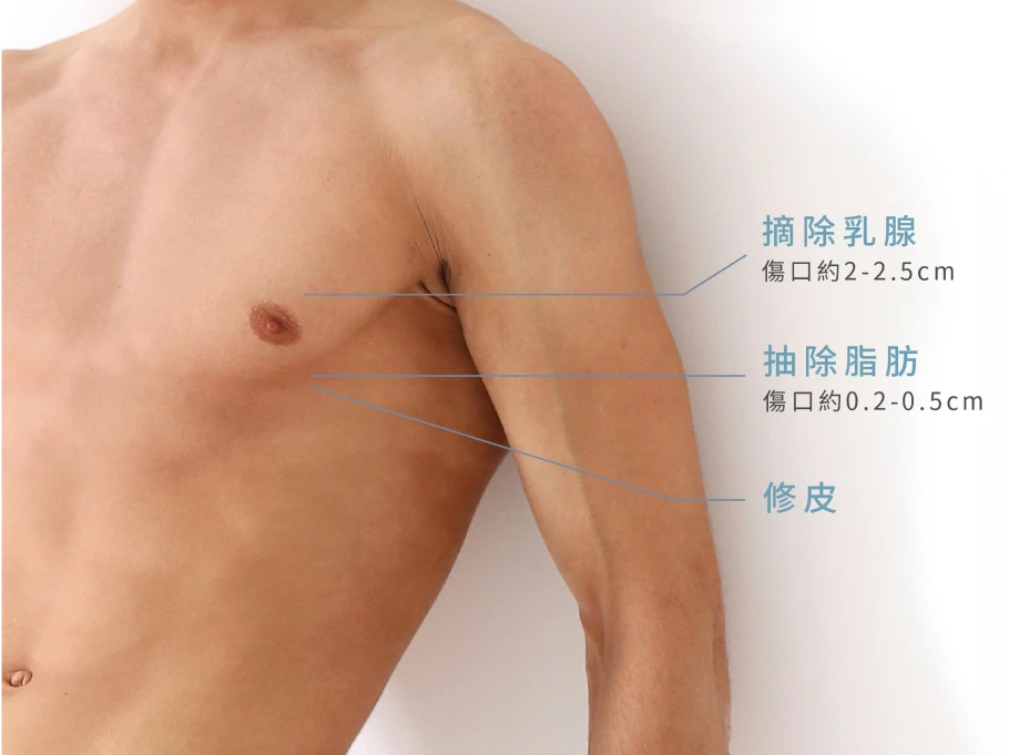 男性女乳抽脂程序