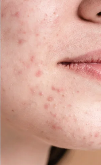 減少粉刺、痘痘量