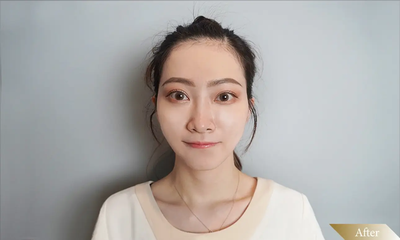 施打海德密絲玻尿酸後-After圖