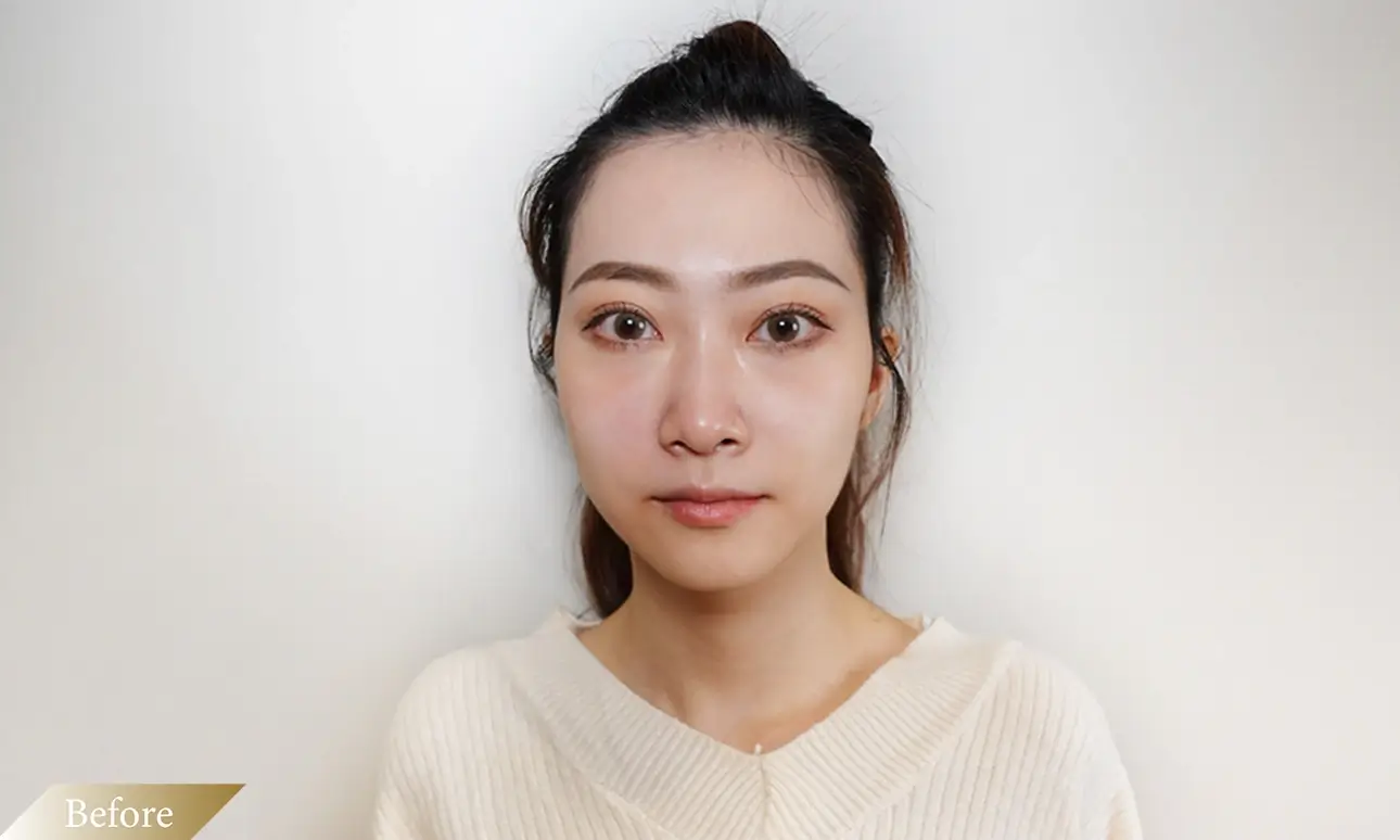 施打海德密絲玻尿酸前-Before圖