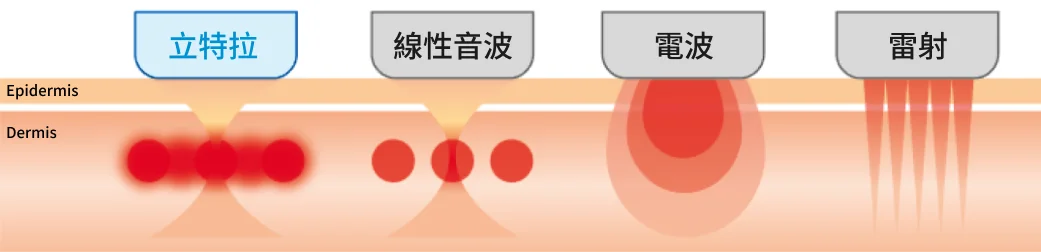 立特拉音波vs其他音電波與雷射