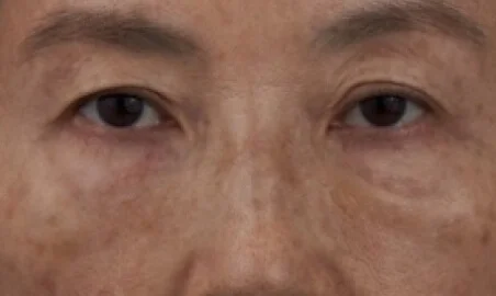 淚溝施打仙女玻尿酸前-After圖