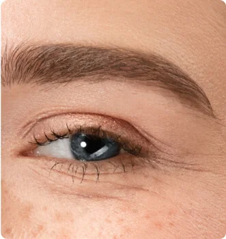 皺紋、細紋增生