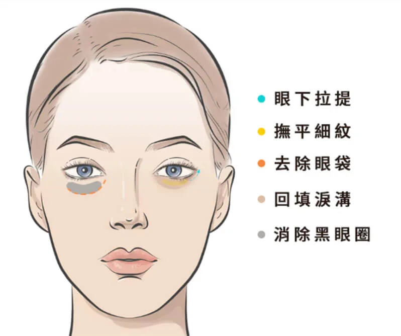 五合一隱痕眼袋手術要點圖片