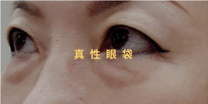 真性眼袋