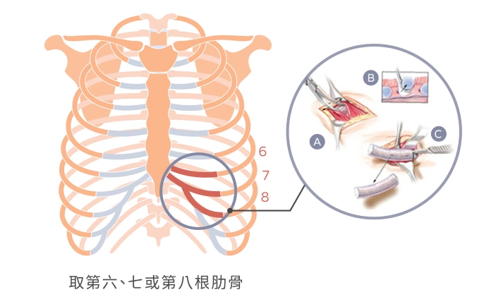 自體肋骨是使用自身的肋軟骨作為隆鼻植入物，在右胸下緣處做切口，取第6或第7或第8根肋軟骨部分，雕刻成合適的鼻模形狀。