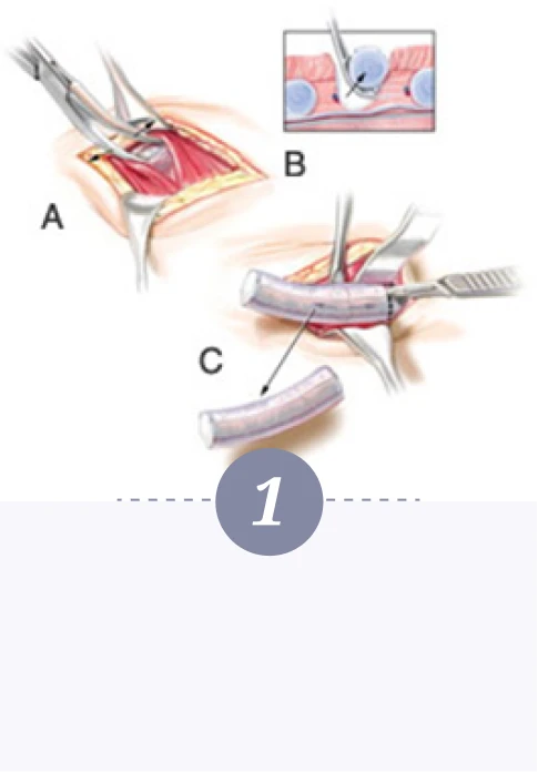 自體肋骨珍珠隆鼻-第一步驟