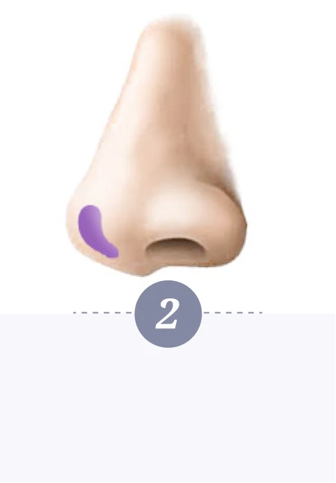 自體肋骨珍珠隆鼻-第二步驟