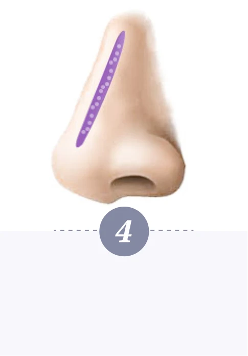 自體肋骨珍珠隆鼻-第四步驟