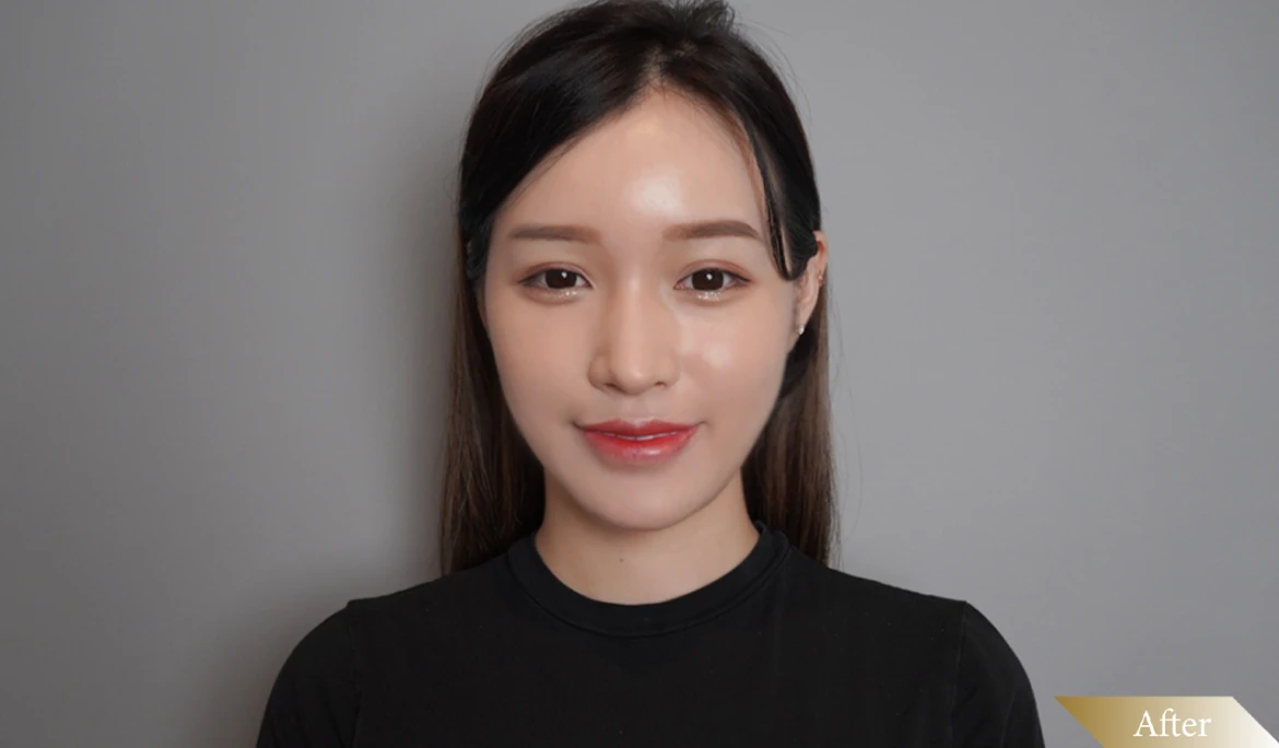 施打鳳凰電波後-After圖