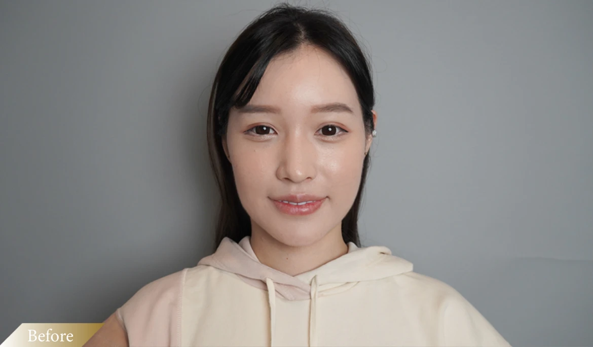 施打鳳凰電波前-Before圖