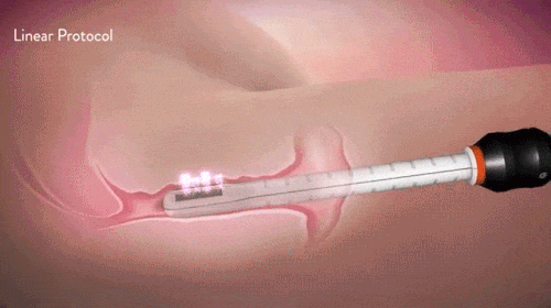 蝴蝶電波施作圖