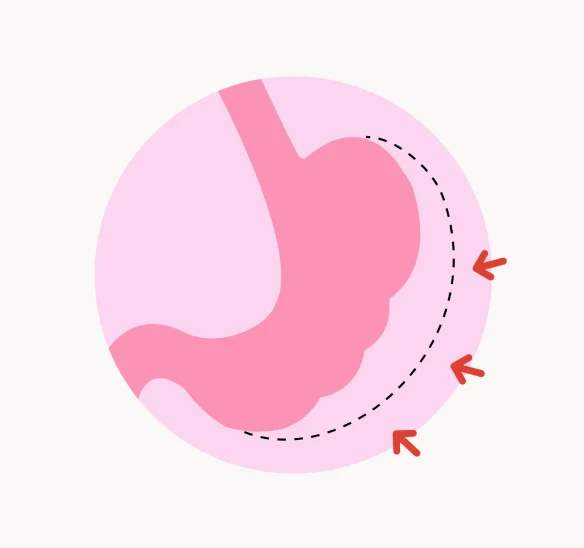 柏氏2.0訂書針縫胃