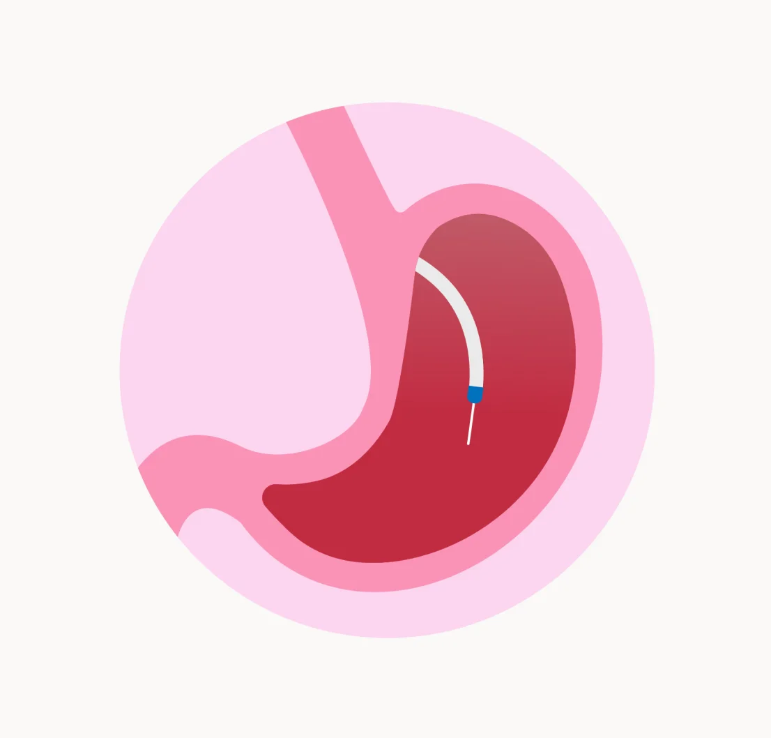 Intragastric Botox illustration