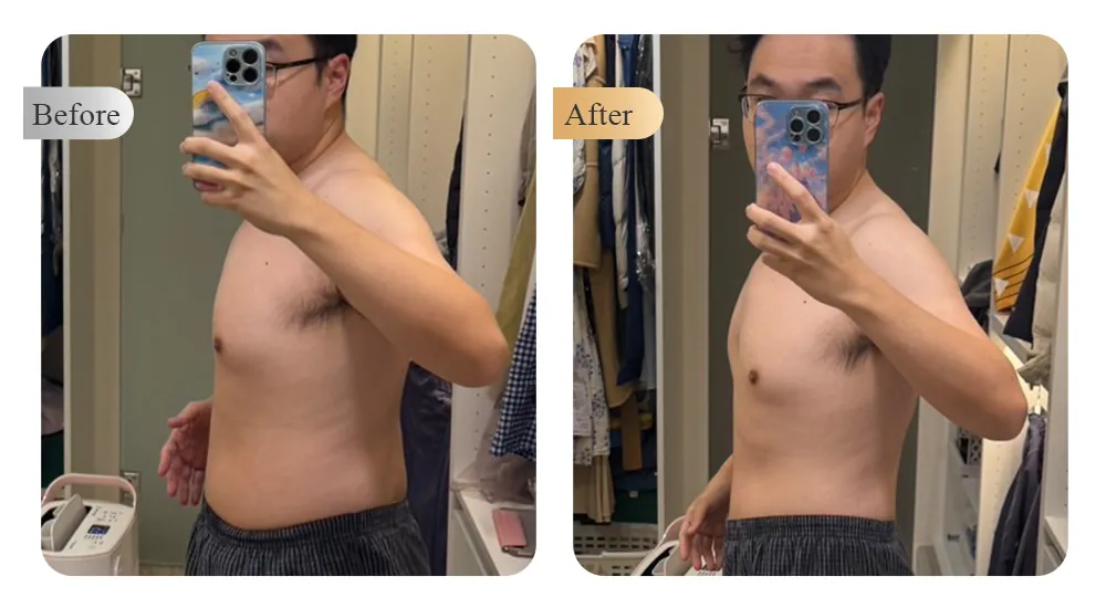 奈思診所科學減重案例 — 男性腰腹術前術後對照