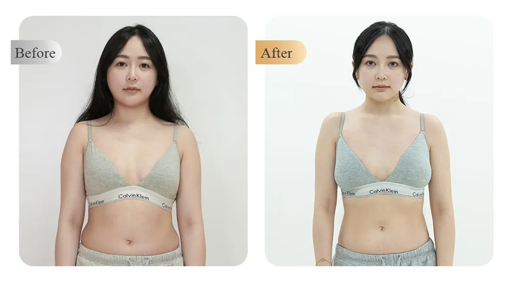 奈思診所科學減重案例 — 女性腰身術前術後對照
